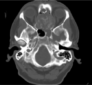 adenocarcinoma-de-etmoides-itnasal